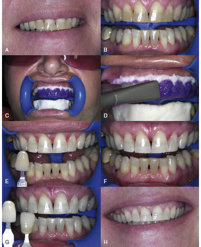 types laser teeth whitening