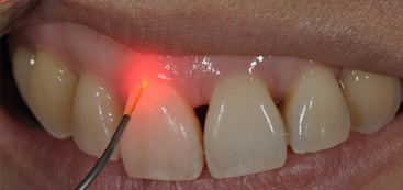 Medical Laser for ENDODONTICS And PERIODONTICS