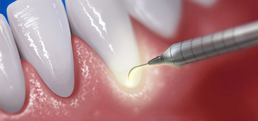 Lasers Fibers for Pediatric Dental Patients