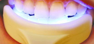 Clinical effect analysis of whitening dental fluorosis with Nd:YAG laser