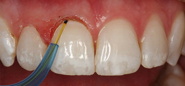 The clinical study on the use of diode laser irradiation in the treatment of periodontal-endodontic combined lesions