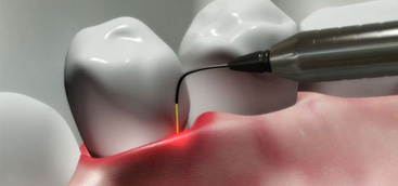 Laser assisted periodontics: A review of the literature