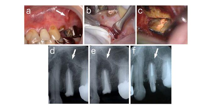 dental laser handpiece