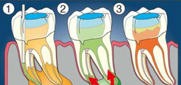 Regeneration Approaches for Dental Pulp and Periapical Tissues with Growth Factors, Biomaterials, and Laser Irradiation