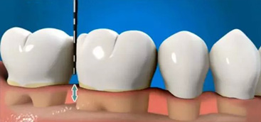 The Development Situation of Material Based on Dental Implant