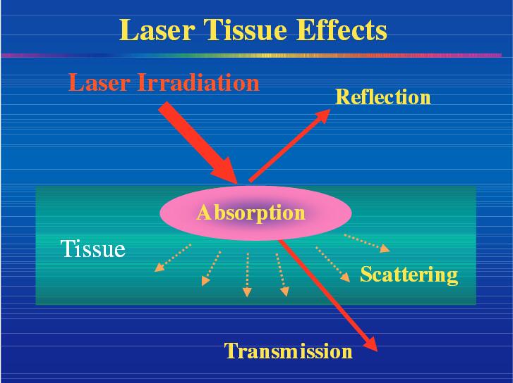 dental laser tips