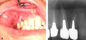 Mediastinal emphysema caused by a dental laser