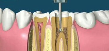 Root and canal morphology of maxillary first premolar teeth in a Ugandan  populatio