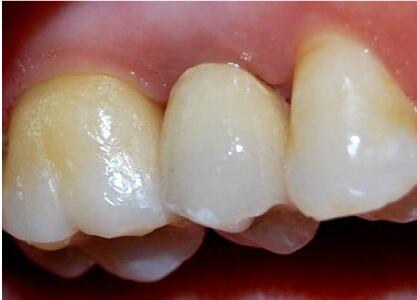 dental laser