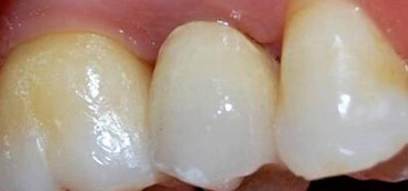 A novel root analogue dental implant using CT scan and CAD/CAM: selective laser melting technology