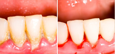 Non surgical periodontal treatment in patients with gingivitis  and moderate periodontitis. 