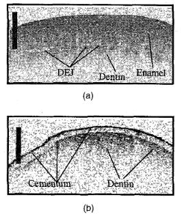 dental laser tips