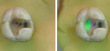 Laser-induced fluorescence to discriminate between a dental composite resin and tooth