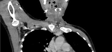 First clinical description of Eggerthia catenaformis bacteremia in a patient with dental abscess