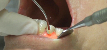 Dental Surgical Laser Market Size 2016 Trend, Global Clinical Trials, Research, Industry Analysis 2021