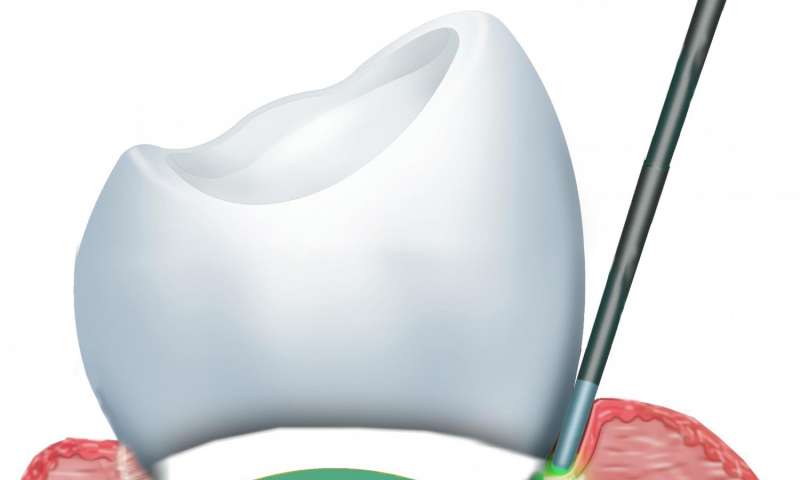 Study suggests benefits of laser treatments for dental problems