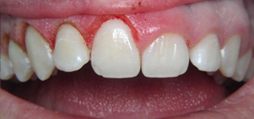 Researchers suggest benefits of using lasers in oral debridement to prevent dental problems