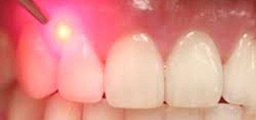 The Versatility and Practicality of an All-Tissue Dental Laser