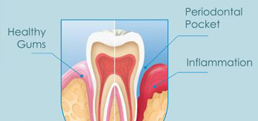 Maxillary Second Molar with Single Root and Single Canal―Case Report