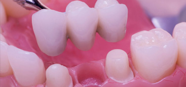 Dental Implants Market to Reach a Valuation of US$ 7,879.5 Million by 2020