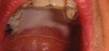 Using 5-Aminolevulinic Acid and Pulsed Dye Laser for Photodynamic Treatment of Oral Leukoplakia