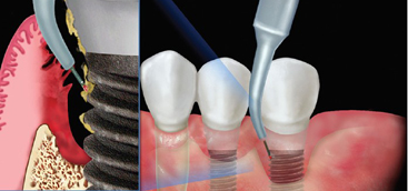 Treatment of Perioral RhytidesA Comparison of Dermabrasion and Superpulsed Carbon Dioxide Laser