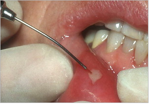 dental laser surgery