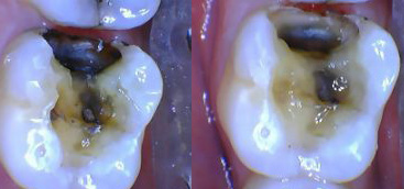 Changing the patient experience: Using a CO(2) laser to remove an amalgam dental restoration without anesthesia