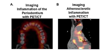 Periodontal disease increases risk of major cardiovascular events