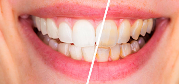 Addressing the Gray Area in Teeth Whitening